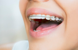 Comprehensive Guide to Retainers and Post-Treatment Care  Comprehensive Guide to Retainers and Post-Treatment Care