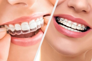 Invisalign vs. Traditional Braces: Which is the Right Choice for You Invisalign vs. Traditional Braces: Which is the Right Choice for You